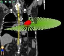 Séminaire découverte : Cancer : origine, propagation, diagnostic et traitement par radiothérapie