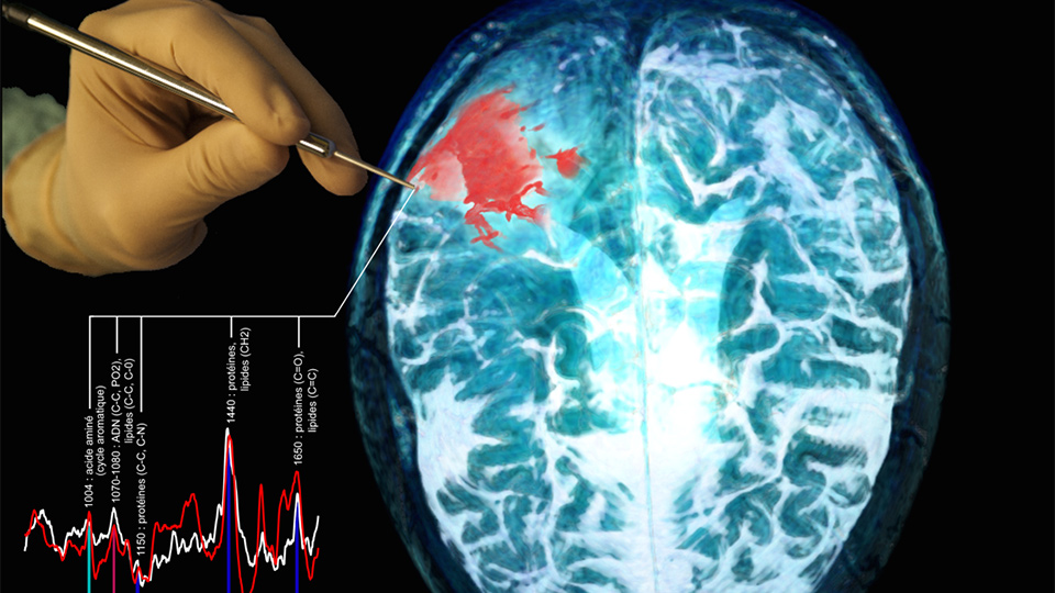 Représentation schématique de la sonde utilisée pour interroger le tissu cérébral pendant la chirurgie. L'image montre une photographie de la sonde tenue par un chirurgien, un spectre Raman associé à du tissu normal et du tissu cancéreux, ainsi qu'une ima