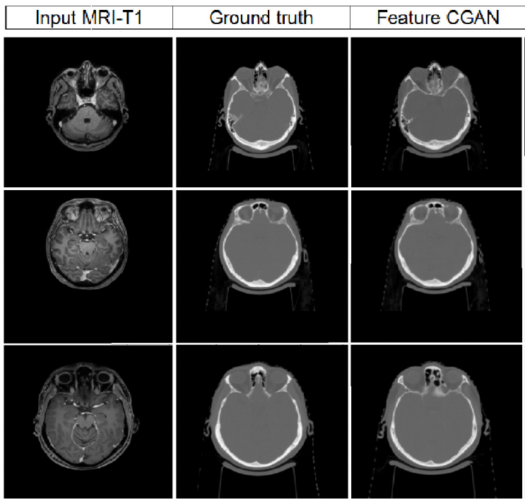 FCGAN qualitative results on Head and Neck MRI to CT Comparison of head and neck input MRI, groundtruth CT and predicted MRI using the proposed FCGAN model
