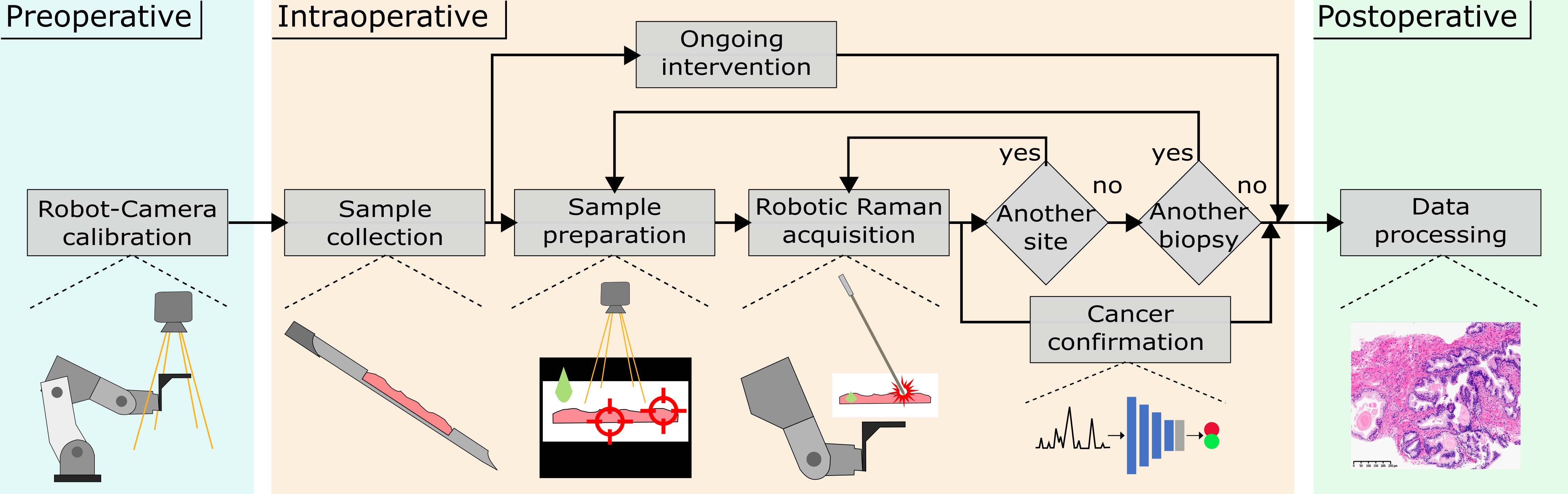Clinical protocol for the cancer confirmation study using Raman spectroscopy. Protocol diagram showing preoperative preparation steps, intraoperative acquisition steps and postoperative histopathological biospy confirmation of tumors.