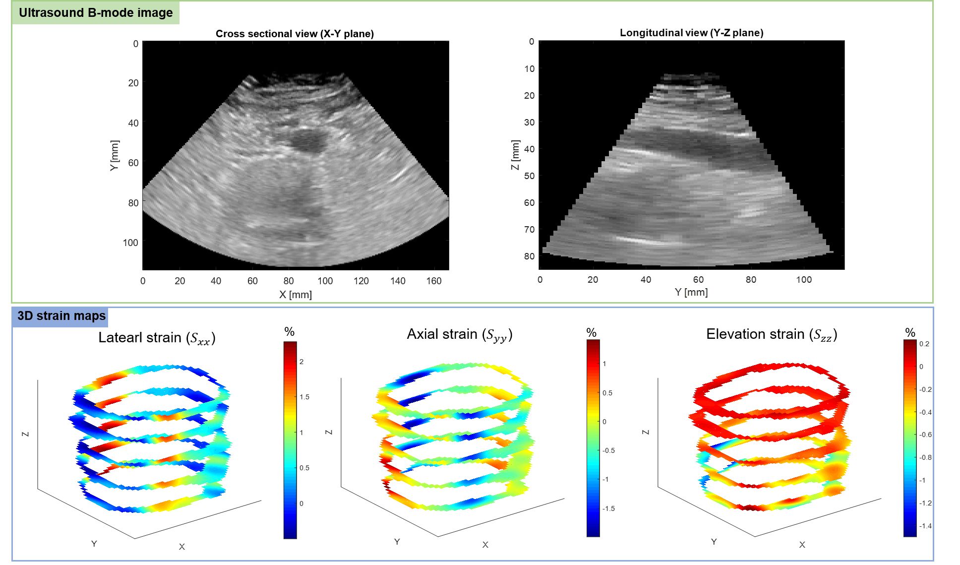 Abdominal Aortic Aneurysm (AAA) strain mapping using 3D Ultrasound Figure of 3D ultrasound cross-sectional and longitudinal view of the aorta and the modeled 3D strain map