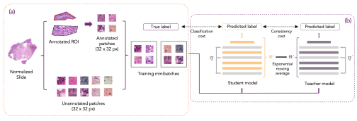 Flowchart of the classification pipeline using a Student/Teacher learning algorithm for colorectal metastasis tissue classification of tumor response grade.