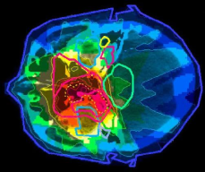 03-Dose_Radiotherapy.png