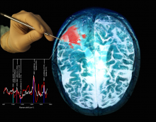 Schematic depiction of the probe being used to interrogate brain tissue during surgery. The image shows a photograph of the probe held by a surgeon, Raman spectral associated with normal brain and cancer, as well as a magnetic resonance image (MRI) of a brain cancer patient with the red area representing the tumor. Schematic depiction of the probe being used to interrogate brain tissue during surgery. The image shows a photograph of the probe held by a surgeon, Raman spectral associated with normal brain and cancer, as well as a magnetic resonance image (MRI) of a brain cancer patient with the red area representing the tumor.