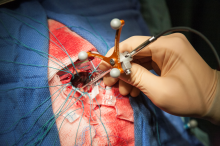 Photographie de la sonde durant une chirurgie.