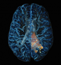 Cancer is often difficult to distinguish in the brain during surgery, causing residual cancer cells to be left behind. These residual cells are the primary cause of recurrence in brain cancer, and result in a poor prognosis for patients. Pr. Leblond and Petrecca have developed a technique for using particular light scattering events (the Raman effect) to detect cancer cells during surgery with a hand-held probe, by measuring molecular interactions with light. The image depicts a 3D rendering of the brain, with the cancer detectable on T1- and T2-weighted MRI (magnetic resonance imaging) in yellow. The bright points indicate cancer detected using Raman spectroscopy (probe measurements were made at these points), as far as 2 cm beyond what is detectable using MRI. By detecting these invasive cancer cells, the surgeon can be provided with a tool to allow for more complete resection and thereby improve patient survival. Cancer is often difficult to distinguish in the brain during surgery, causing residual cancer cells to be left behind. These residual cells are the primary cause of recurrence in brain cancer, and result in a poor prognosis for patients. Pr. Leblond and Petrecca have developed a technique for using particular light scattering events (the Raman effect) to detect cancer cells during surgery with a hand-held probe, by measuring molecular interactions with light. The image depicts a 3D rendering of the brain, w