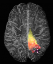 Cancer is often difficult to distinguish in the brain during surgery, causing residual cancer cells to be left behind. These residual cells are the primary cause of recurrence in brain cancer, and result in a poor prognosis for patients. Pr. Leblond and Petrecca have developed a technique for using particular light scattering events (the Raman effect) to detect cancer cells during surgery with a hand-held probe, by measuring molecular interactions with light. The image depicts a 3D rendering of the brain, with the cancer detectable on T1- and T2-weighted MRI (magnetic resonance imaging) in red and yellow, respectively. The bright points indicate cancer detected using Raman spectroscopy (probe measurements were made at these points), as far as 2 cm beyond what is detectable using MRI. By detecting these invasive cancer cells, the surgeon can be provided with a tool to allow for more complete resection and thereby improve patient survival. Cancer is often difficult to distinguish in the brain during surgery, causing residual cancer cells to be left behind. These residual cells are the primary cause of recurrence in brain cancer, and result in a poor prognosis for patients. Pr. Leblond and Petrecca have developed a technique for using particular light scattering events (the Raman effect) to detect cancer cells during surgery with a hand-held probe, by measuring molecular interactions with light. The image depicts a 3D rendering of the brain, w