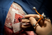 Photographie de la sonde durant une chirurgie. 