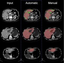 Segmentation de lésions dans un organe à l’aide de techniques d’apprentissage automatique, à partir d’une image source de tomodensitométrie (CT scan) (à gauche), réalisée par une architecture de réseaux de neurones convolutifs (au centre) et manuellement (à droite). Photo : Eugene Vorontsov 