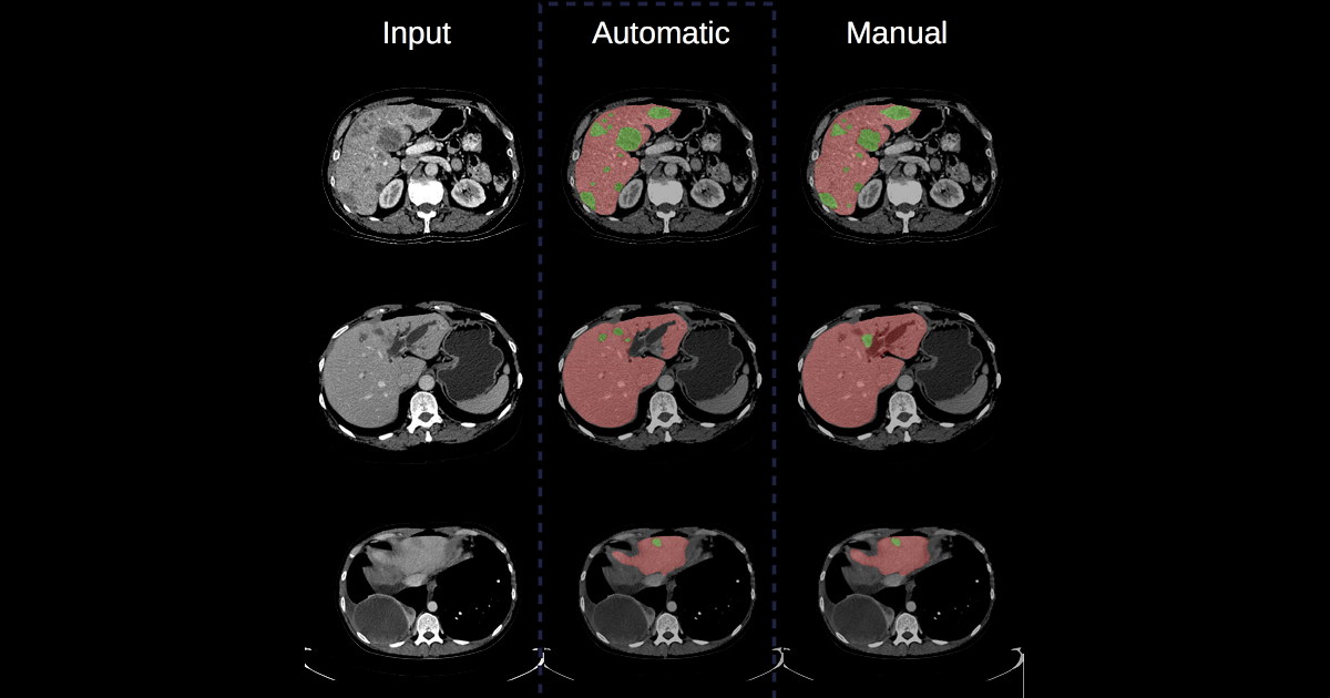 Segmentation of lesions in an organ using machine learning techniques, from a CT-scan image (left), performed by a convolutional neural network architecture (center) and manually (right). (Credit : Eugene Vorontsov) Segmentation of lesions in an organ using machine learning techniques, from a CT-scan image (left), performed by a convolutional neural network architecture (center) and manually (right). (Credit : Eugene Vorontsov)